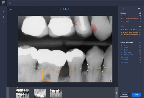 Figure: Overjet’s Clinical Intelligence Platform displays a radiograph with dental artificial intelligence findings. (PRNewsfoto/Overjet)